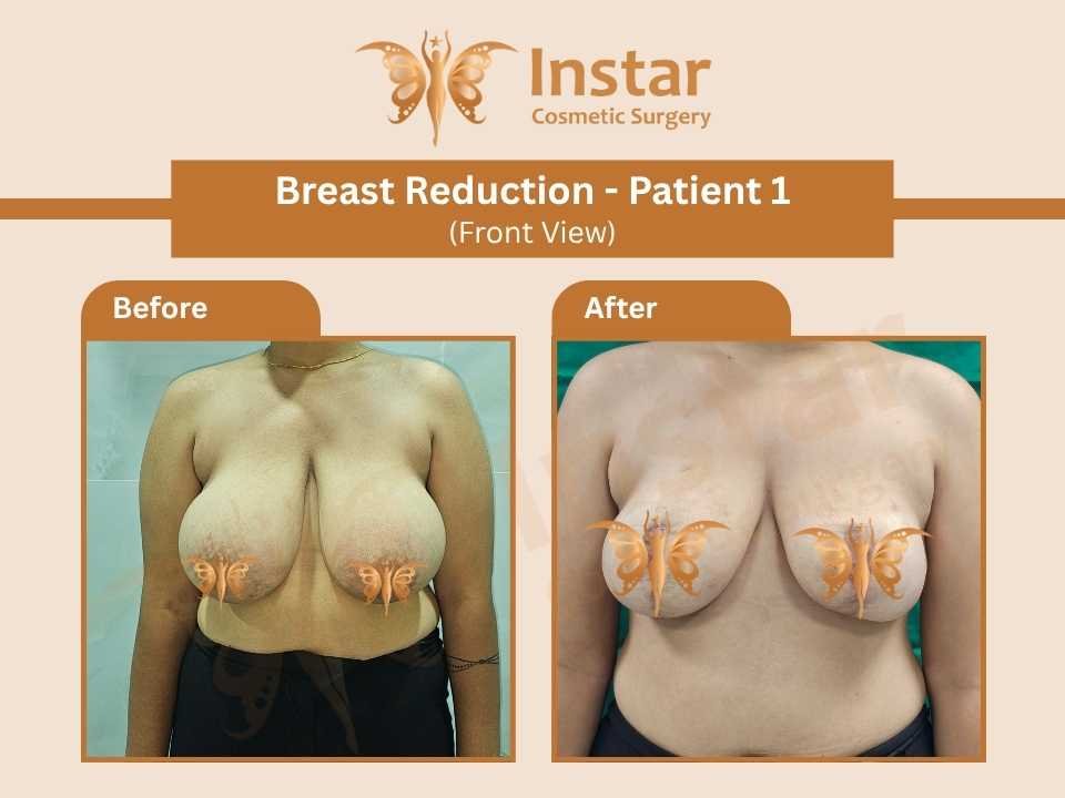Breast Implant on Table-2